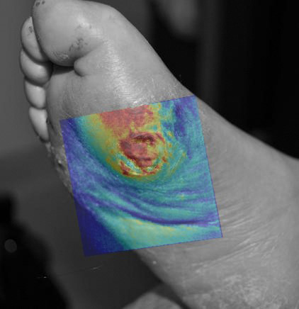 Hyperspectral Imaging Reveals Wound Problems | Spectroscopy Europe/World