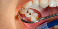 Photo of caries in human teeth.
